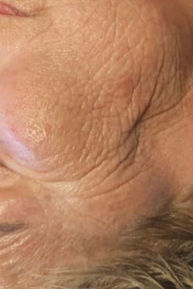 Gesichtslinien nach der kosmetischen Anwendung