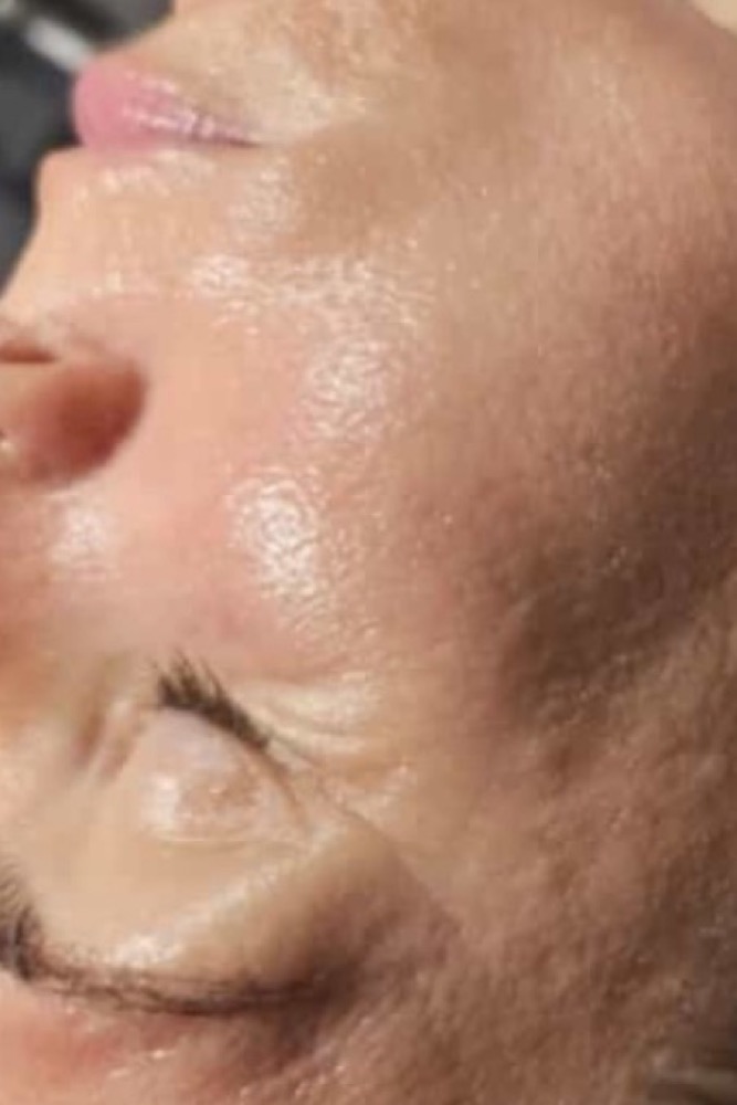 Fältchen rund um die Augen nach der Pflege