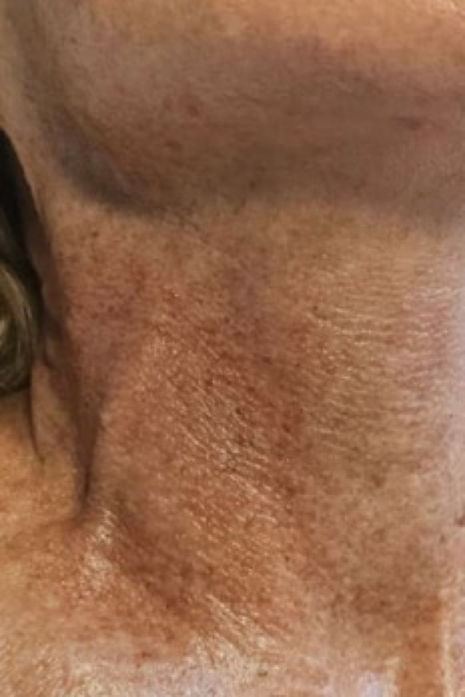 Hautlinien am Hals nach der kosmetischen Anwendung
