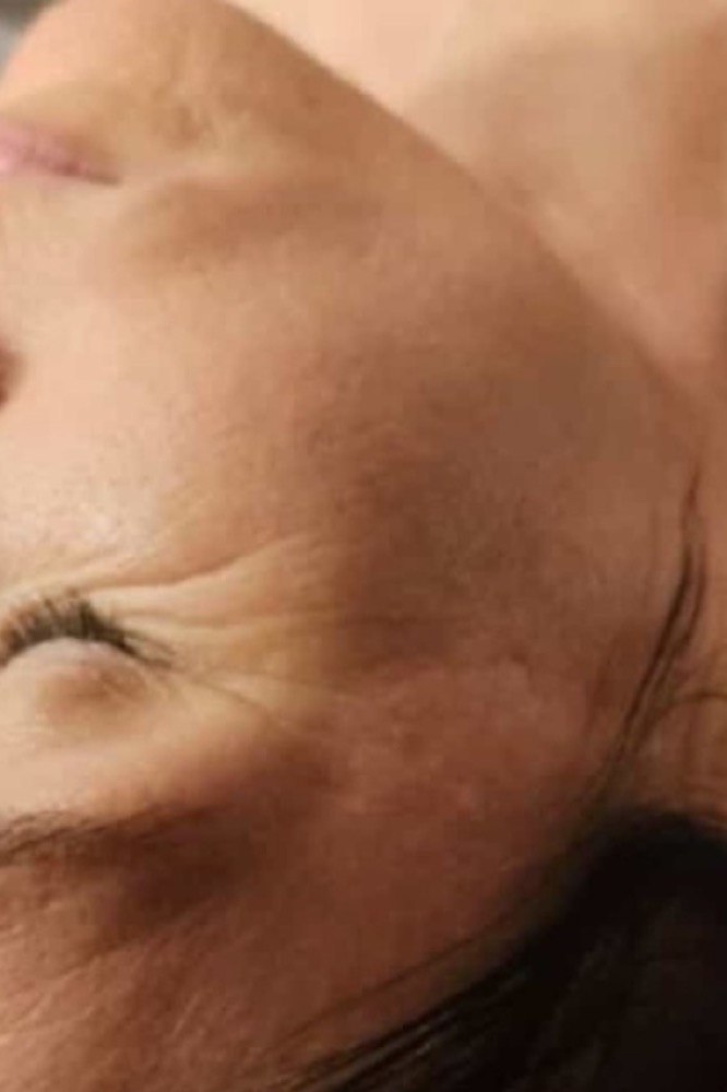 Fältchen rund um die Augen vor der Pflege
